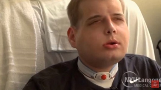 火事で顔が溶けた元消防士にイケメン選手の顔面を移植！　の画像1